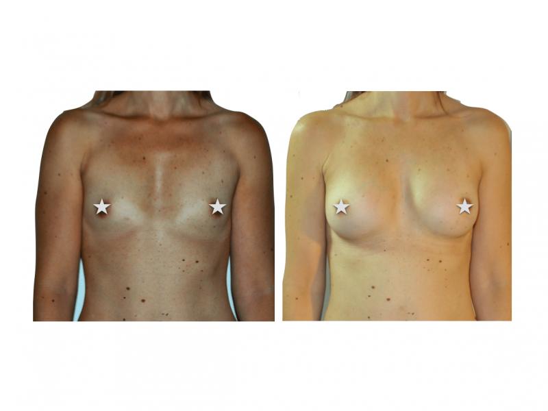 Prices of composite breast augmentation in Istanbul, Turkey