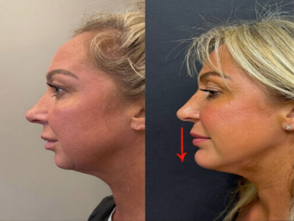 увеличения подбородка в Стамбуле