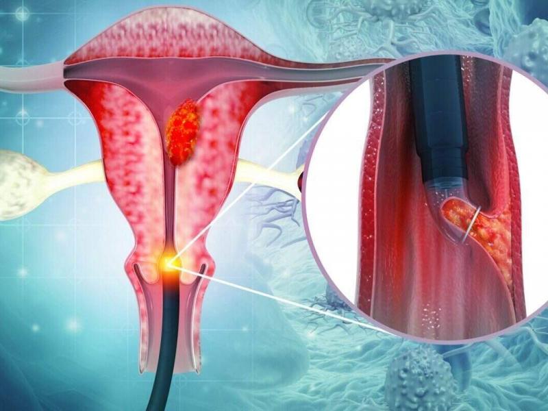 Biopsy of the Endometrium Turkey 