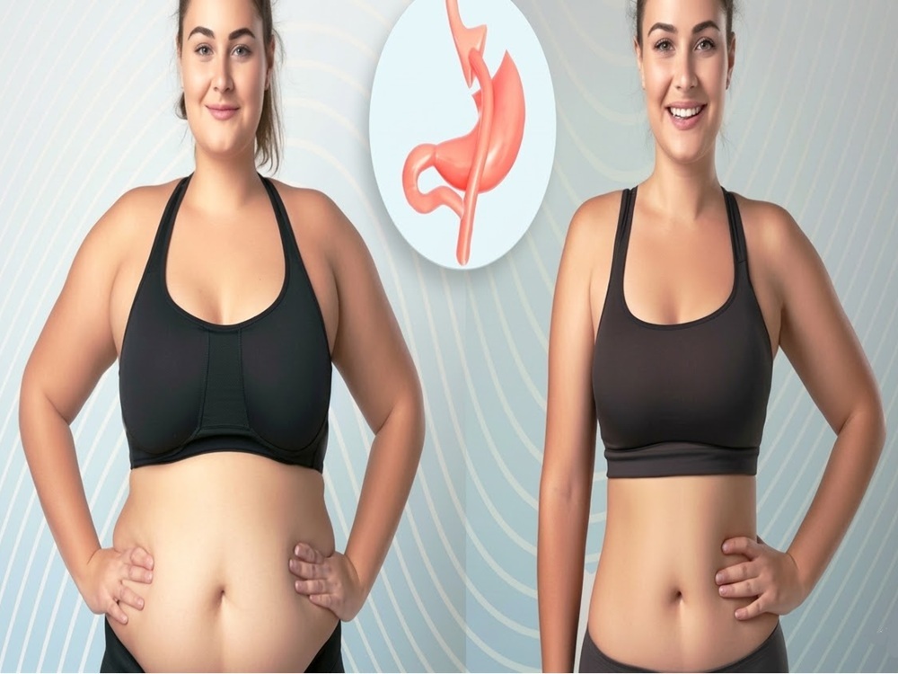 Cirugía de bypass gástrico en Turquía