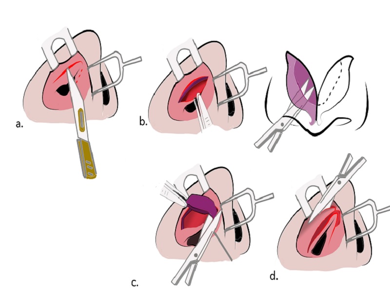 Nose tip surgery 3 Turkey Nose tip surgery 3 Turkey
