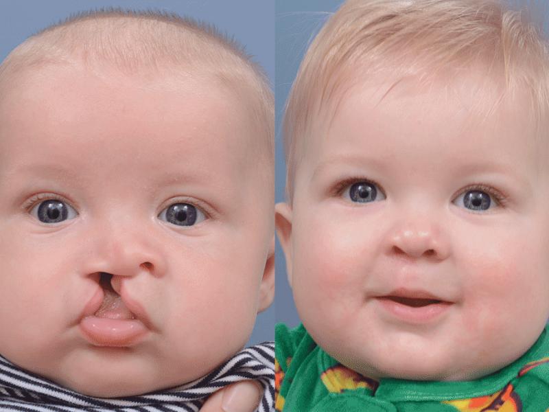 Cleft lip nasal deformity surgery Turkey 