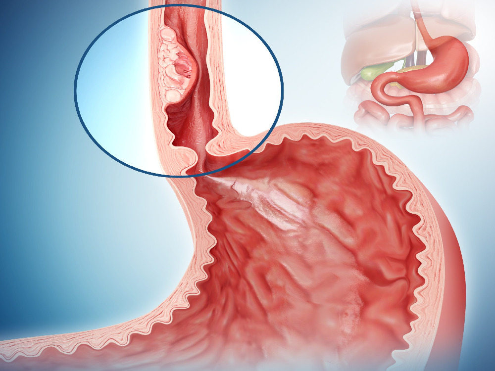 diverticule de l'œsophage