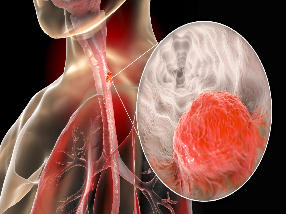 Treatment of esophageal diverticula in Turkey