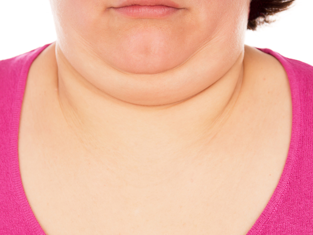 Réduction du double menton