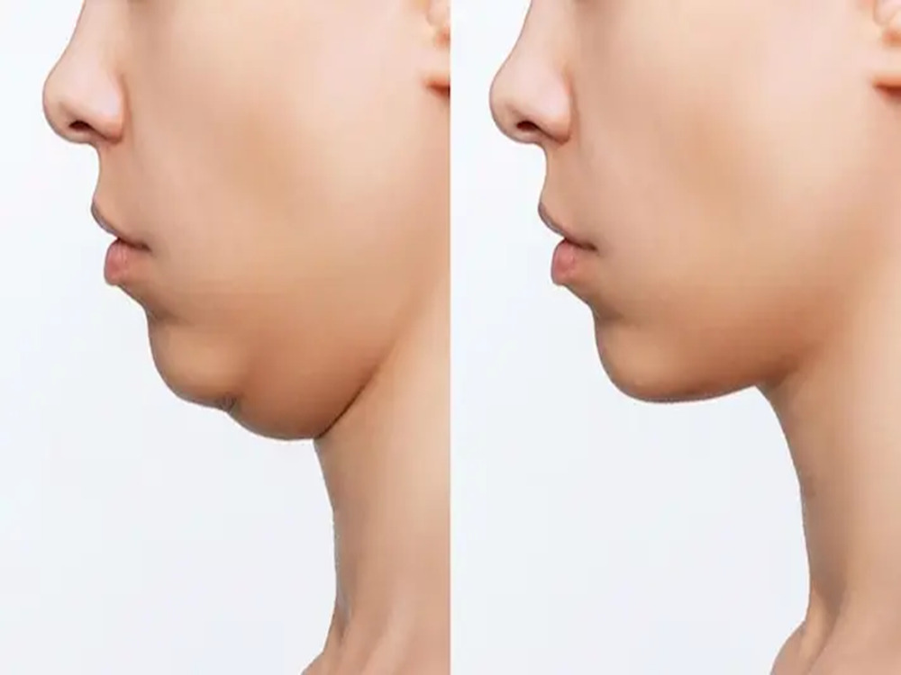 عملية تنحيف الذقن عملية تنحيف الذقن