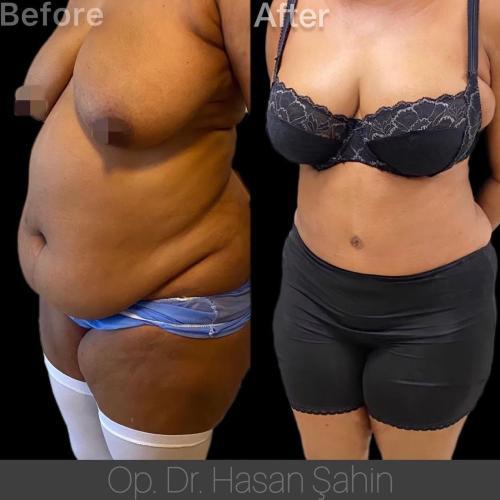 صور قبل وبعد لمرضانا 5 عمليات التجميل في تركيا,أفضل مراكز التجميل في تركيا,افضل دكتور تجميل في تركيا,تجربتي,إسطنبول