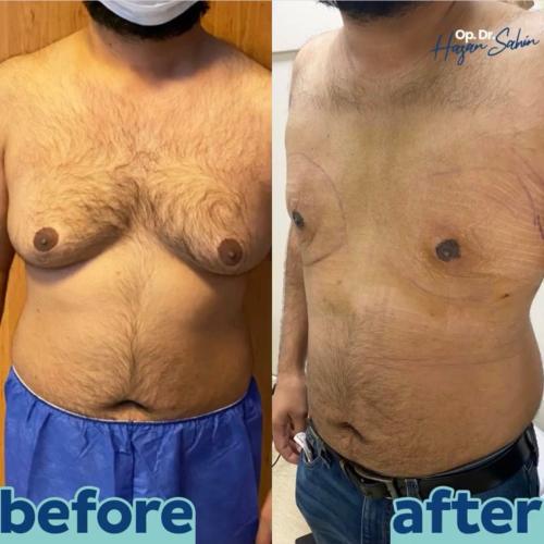 صور قبل وبعد لمرضانا 4 عمليات التجميل في تركيا,أفضل مراكز التجميل في تركيا,افضل دكتور تجميل في تركيا,تجربتي,إسطنبول