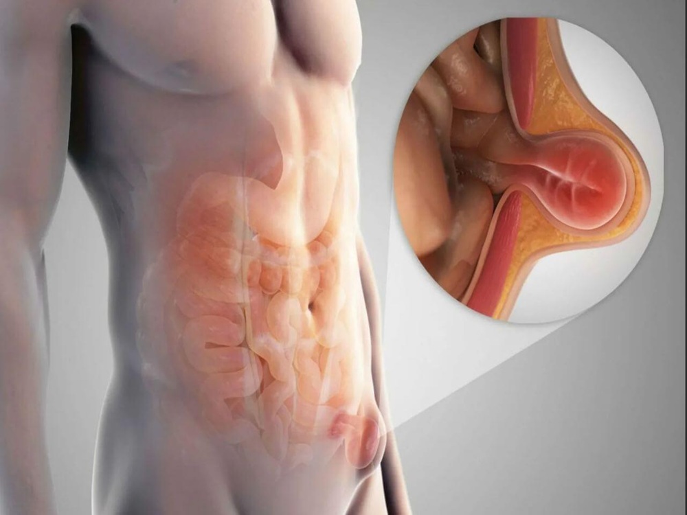 ¿Quién puede beneficiarse de la cirugía de hernia abdominal? 2026