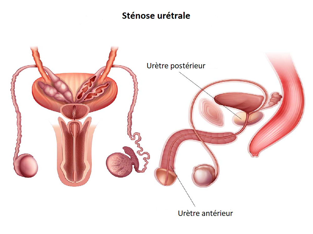 Diagnostic d'une sténose urétrale en Turquie 2024