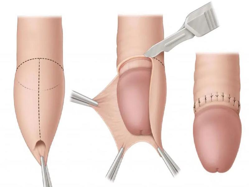 CHF (Circumcision Hydrocele Frenuloplasty) Surgical Center