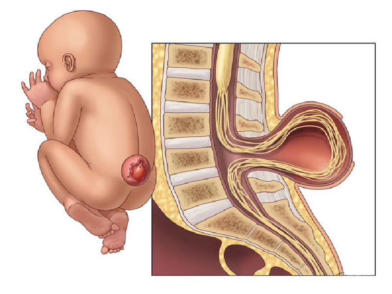 spina bifida occulta dimple