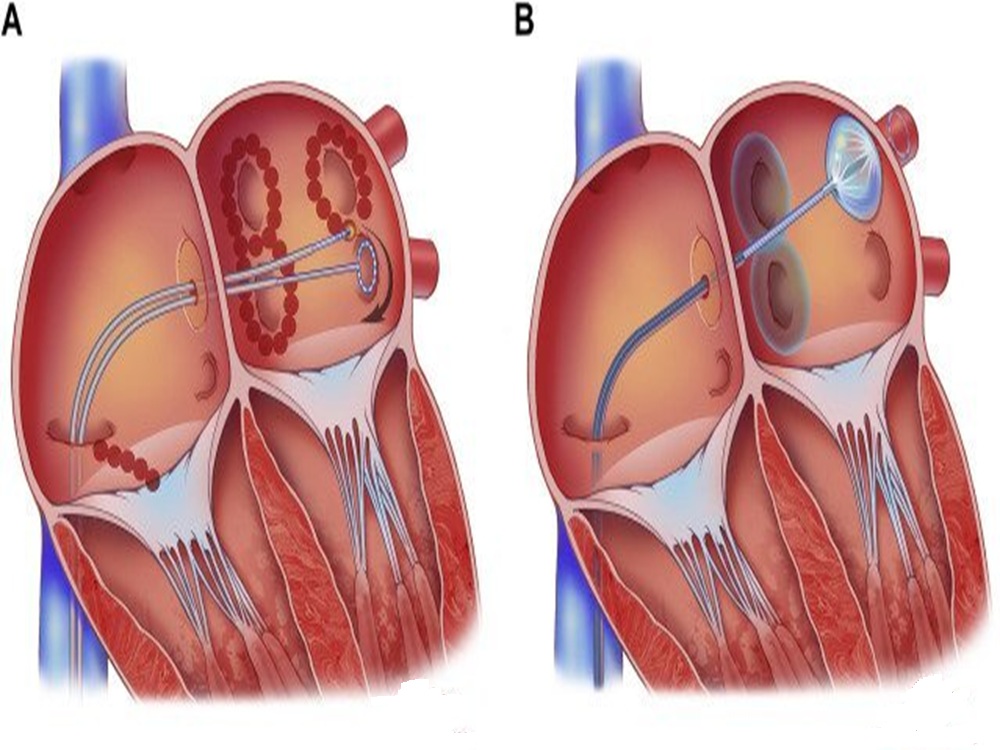 procédure de cryoablation cardiaque procédure de cryoablation cardiaque