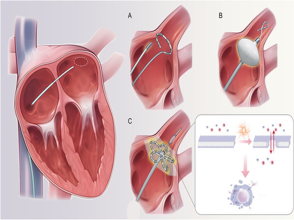 cryoablation cardiaque cryoablation cardiaque