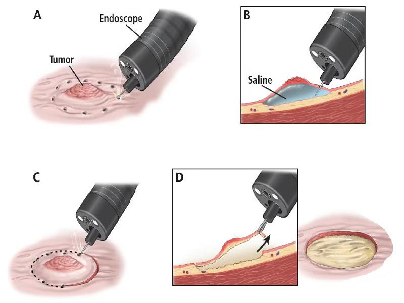 endoscopic submucosal dissection ESD