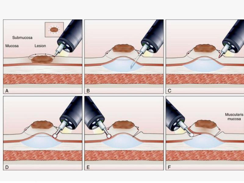 disección endoscópica de la submucosa