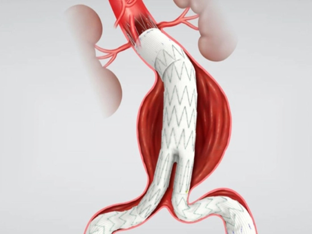 endovascular approach