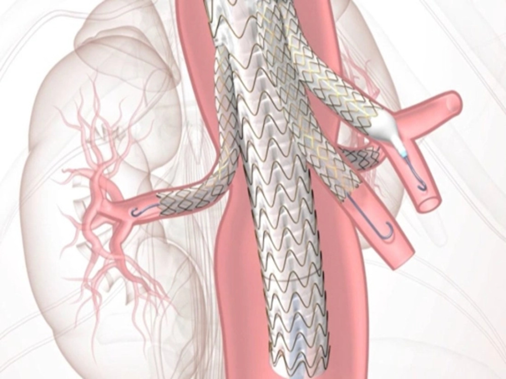 endovascular EVAR & TEVAR procedures