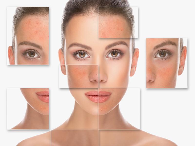 Side Effects of Chemical Peels 2024