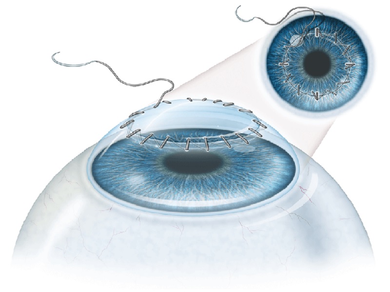 Greffe de cornée en Turquie Avis, Prix à partir de 10000