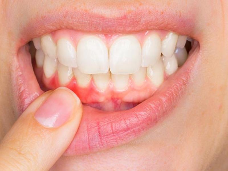 تطعيم وزراعة اللثة تركيا تطعيم وزراعة اللثة تركيا