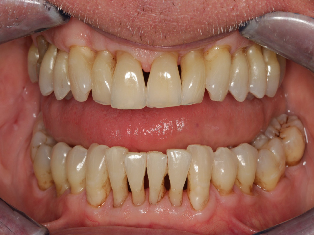Causes of gingival recession 2025 Causes of gingival recession 2025