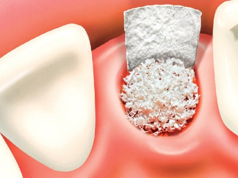 Greffe osseuse dentaire 