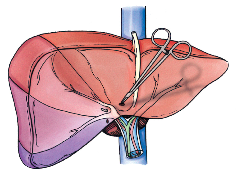 hepatectomy in Turkey