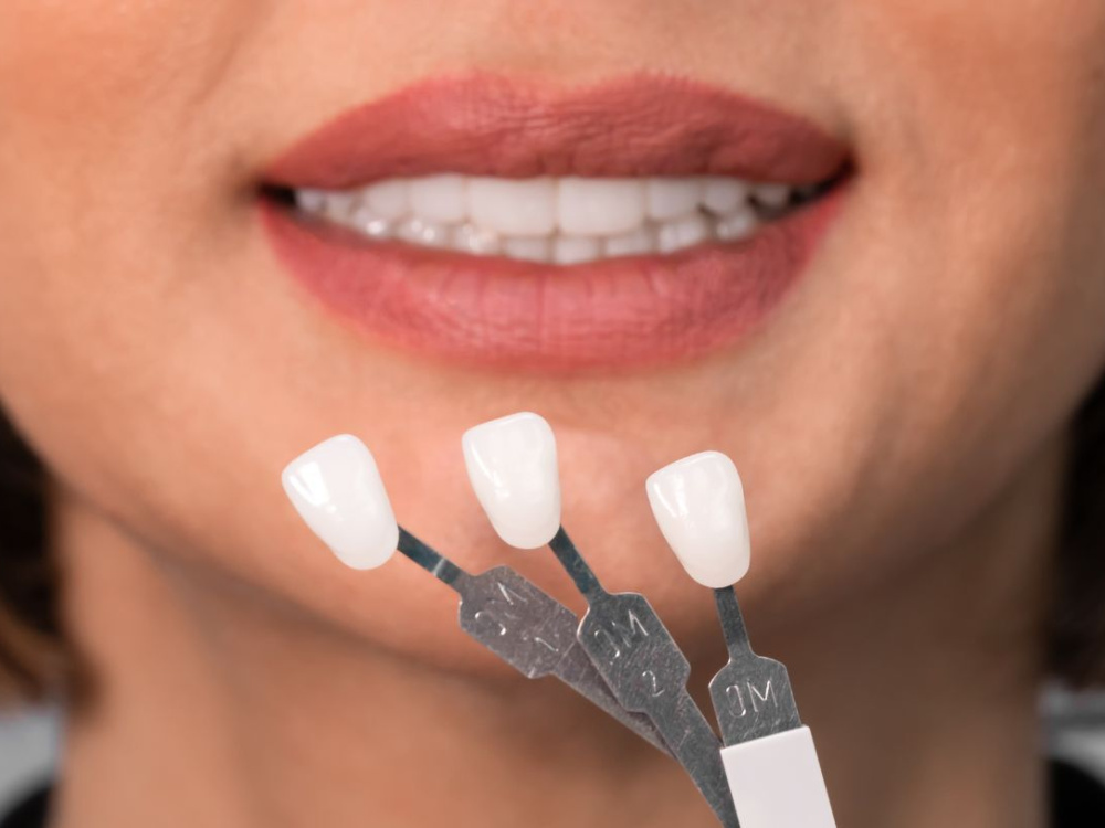 Как проходит лечение Голливудская улыбка в Турции? 2026 Как проходит лечение Голливудская улыбка в Турции? 2026