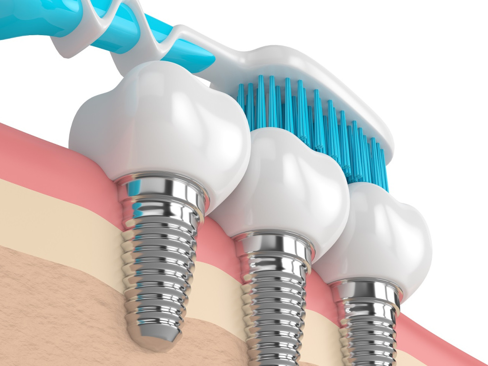 Tooth implant care 2026