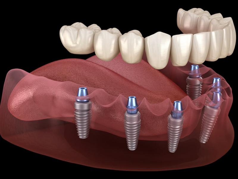 Implant dentaire à mise en charge immédiate Turquie 