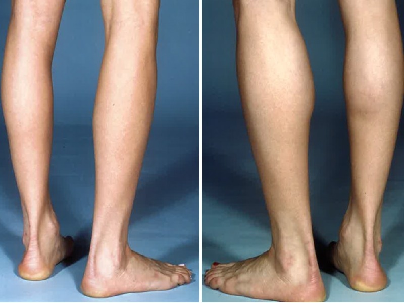  Photos: Before / After 0 in Turkey Calf Augmentation,Calf implants,Surgery,Turkey,Implants,Istanbul,Cost