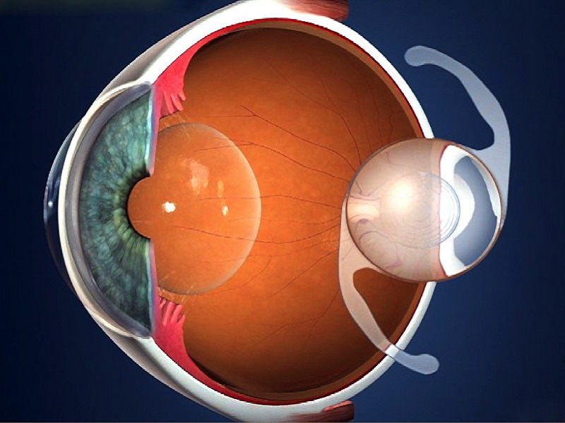 Intraocular lens implantation in Turkey