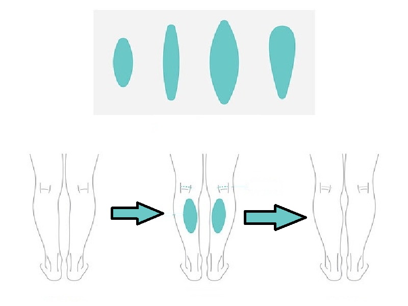 Implant des Mollets 