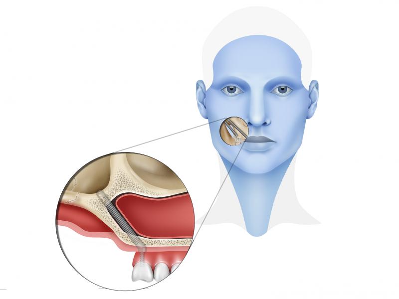 Implant zygomatique Turquie 