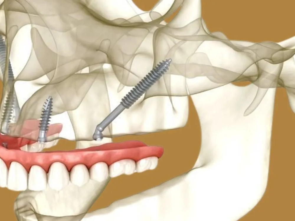 Avantages de la chirurgie des implants zygomatiques en Istanbul, Turquie 2026