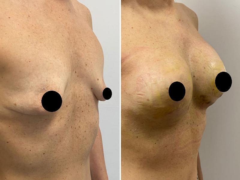 Увеличение груди через подмышечный доступ - фото до и после
