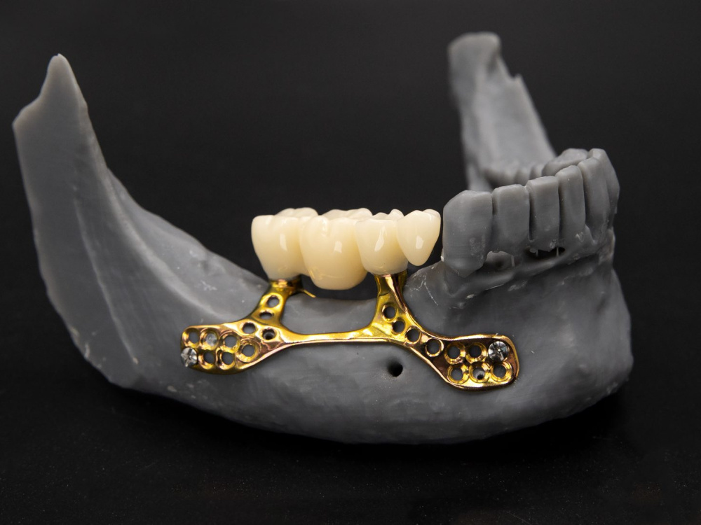 How is a subperiosteal implant placed in Istanbul? 2026