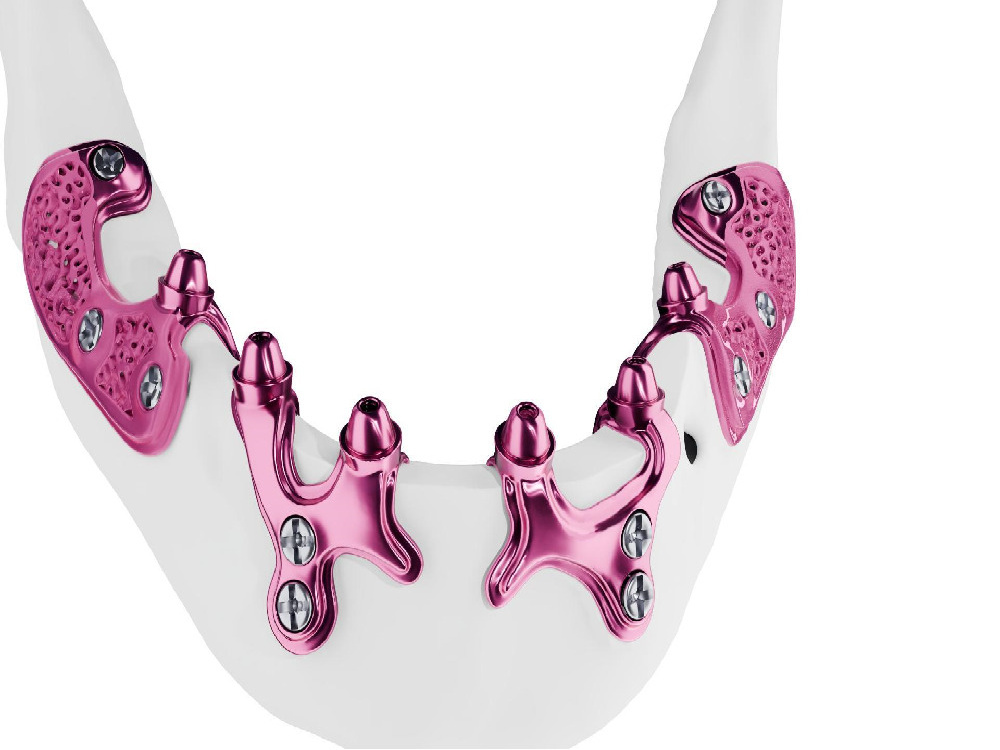 implants sous-périostés en Turquie