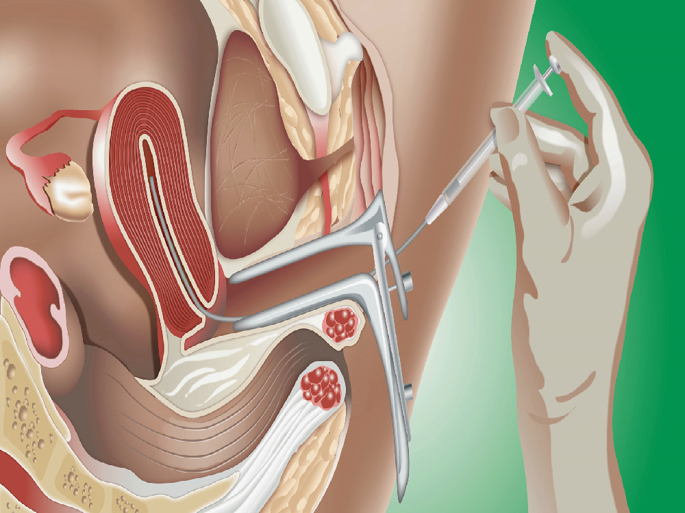 ¿Quiénes pueden beneficiarse de la inseminación artificial en Turquía? 2026