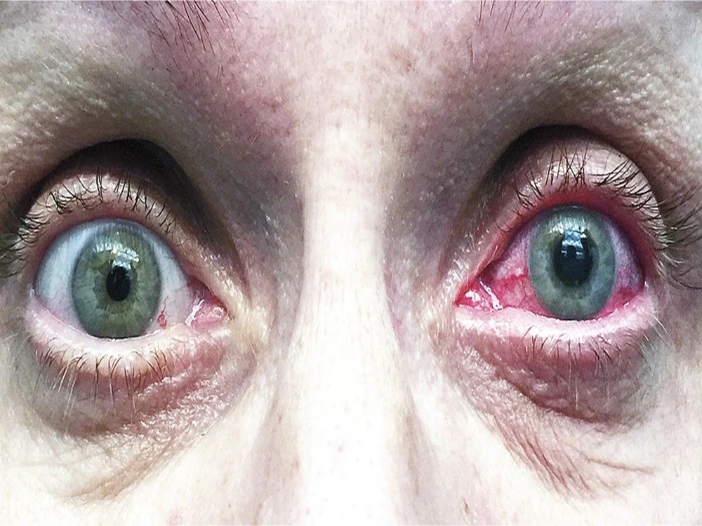 زرق انسداد الزاوية