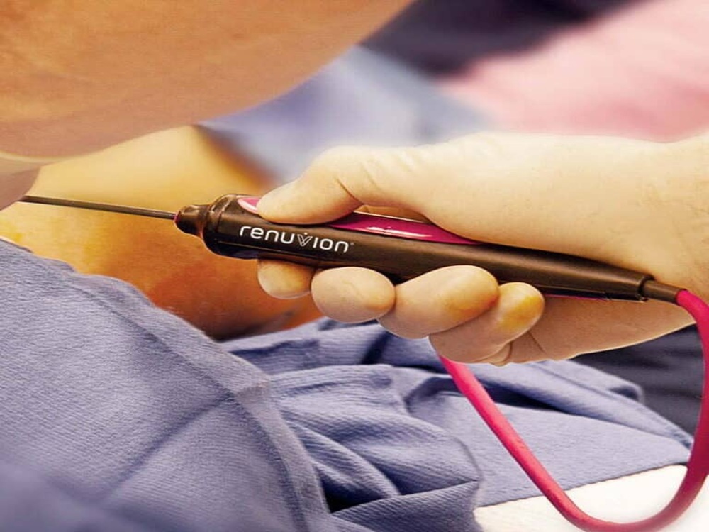 Техника Renuvion J-Plasma Техника Renuvion J-Plasma