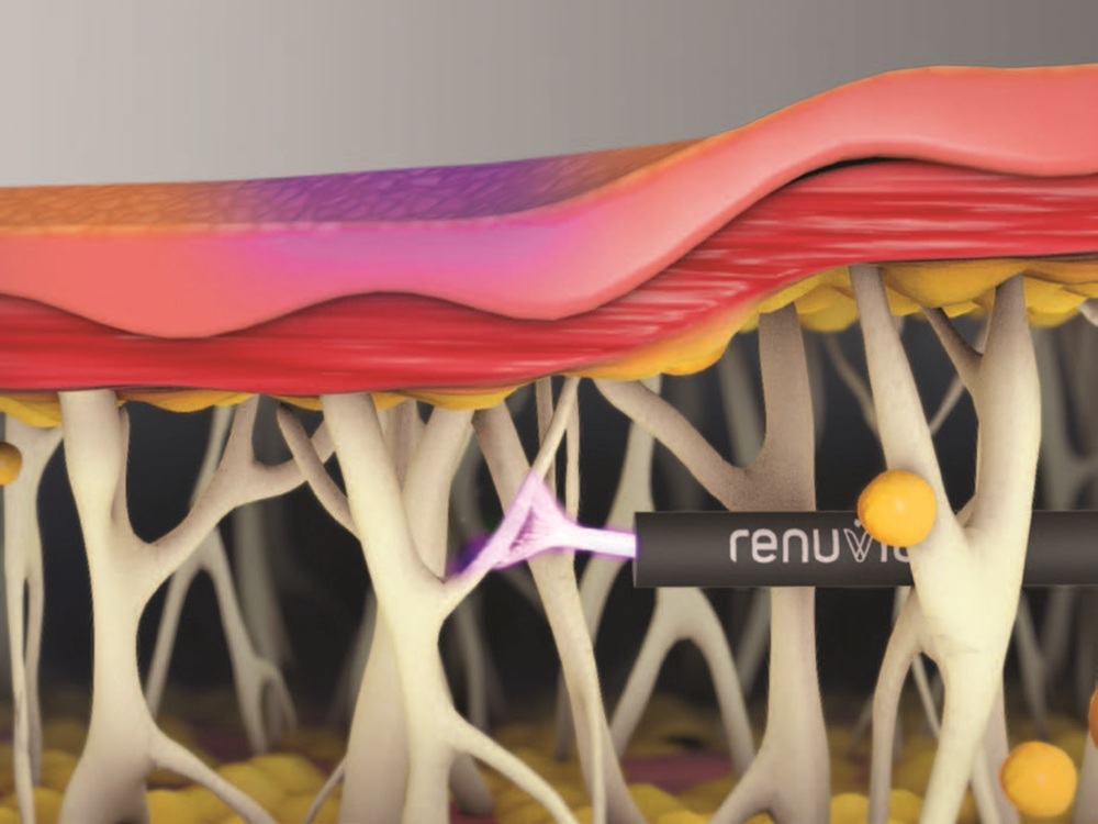 Renuvion J-Plasma Renuvion J-Plasma