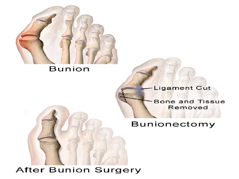 Bunion Surgery Turkey,Costs, Reviews, Photos, Prices