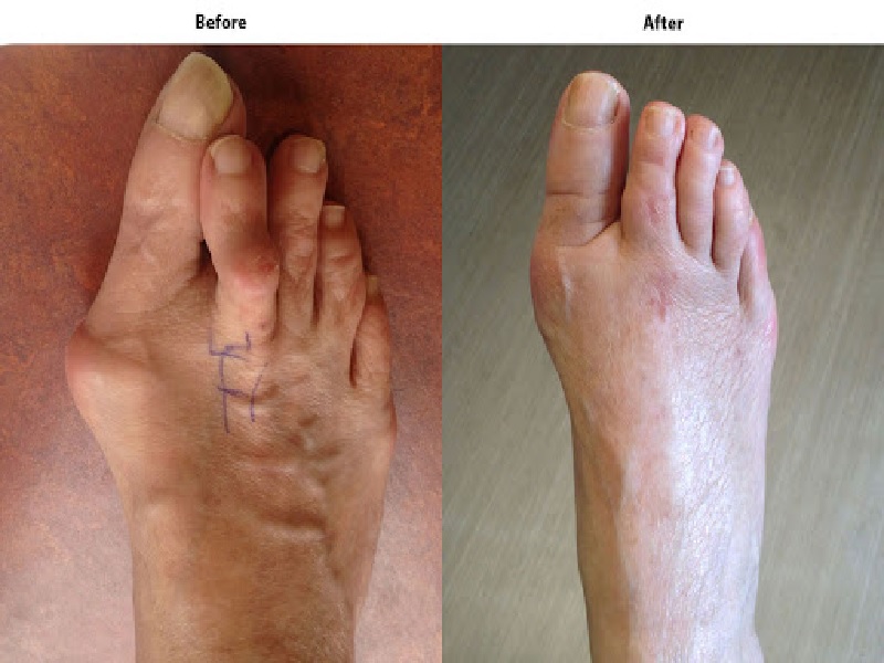 Bunion Surgery Turkey,Costs, Reviews, Photos, Prices