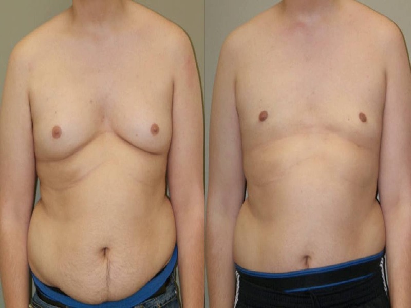  Photos: Before / After 0 in Turkey male boobs, surgery, price, turkey, doctor, clinic
