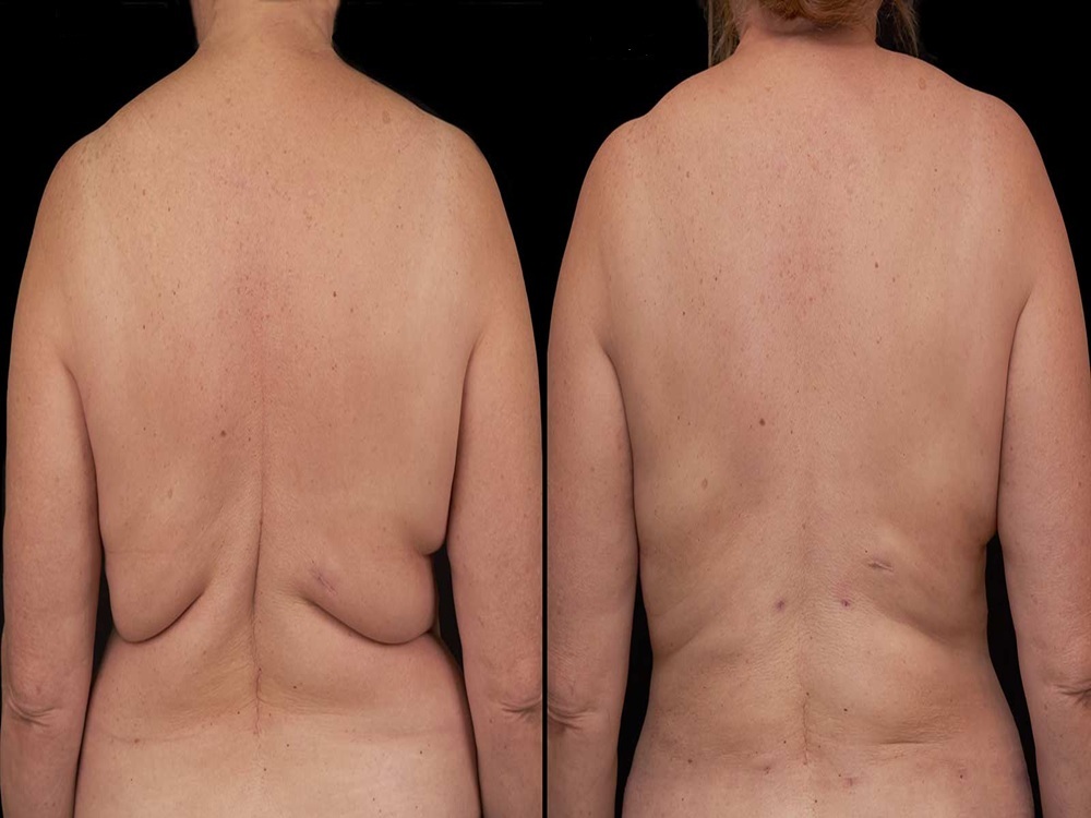 Cirugía de lifting de espalda en Estambul, Turquía