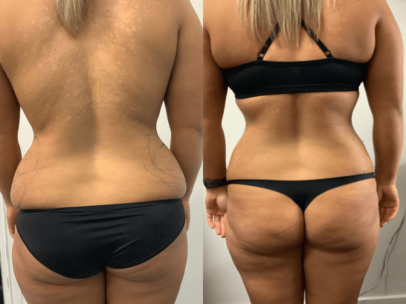  Photos: Before / After 0 in Turkey hip liposuction, turkey, love handles, saddlebags, results, risks, complications