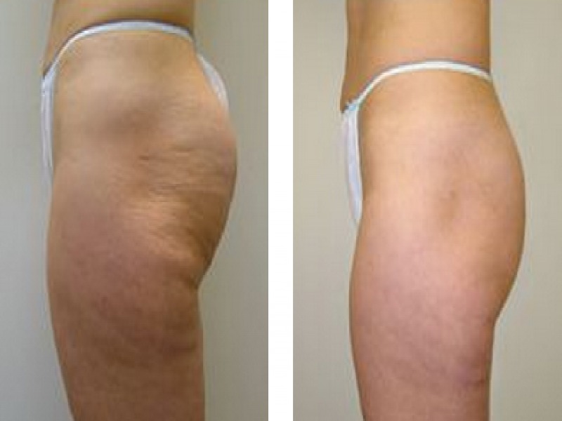  Photos: Before / After 0 in Turkey Laser liposuction, price, results, procedure, doctor, cosmetic surgeon, turkey, istanbul, clinic, hospitals