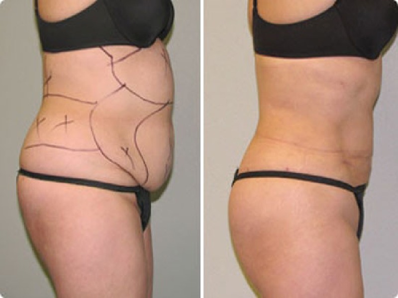  Photos: Before / After 0 in Turkey Laser liposuction, price, results, procedure, turkey, istanbul